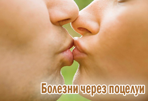 Какие болезни передаются через поцелуи